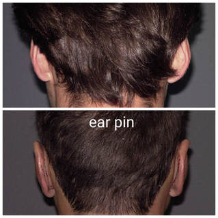 Ear pin or Otoplasty will correct the shape of the ears and make them remain closer to the head. Short operation, but long recovery time, will get you that slick look you are waiting for!