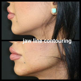A well defined jaw line is synonym of youth and beauty. It is all done with and expert hand and a few drops of filler! Texas treatment done in Dubai! Ladies get that nice flowing, feminine line, men the voluntary, masculine line. Magic touch!